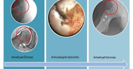 Kalça artroskopisi – Femoroasetabular sıkışma